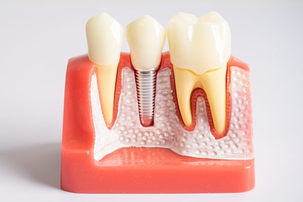 dental-implant-artificial-tooth-roots-into-jaw-r-2024-05-09-19-08-24-utc-scaled.jpg