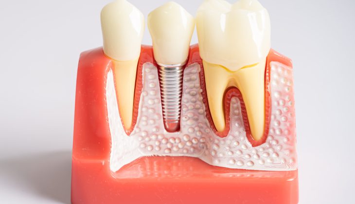 dental-implant-artificial-tooth-roots-into-jaw-r-2024-05-09-19-08-24-utc-scaled.jpg